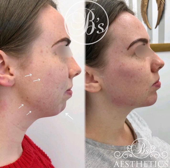 cheek-enhancement-2
