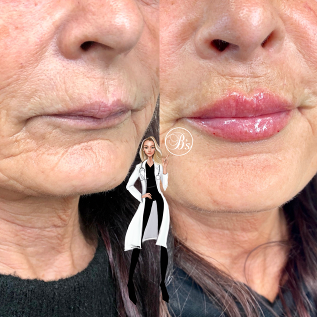 lip-fillers-1