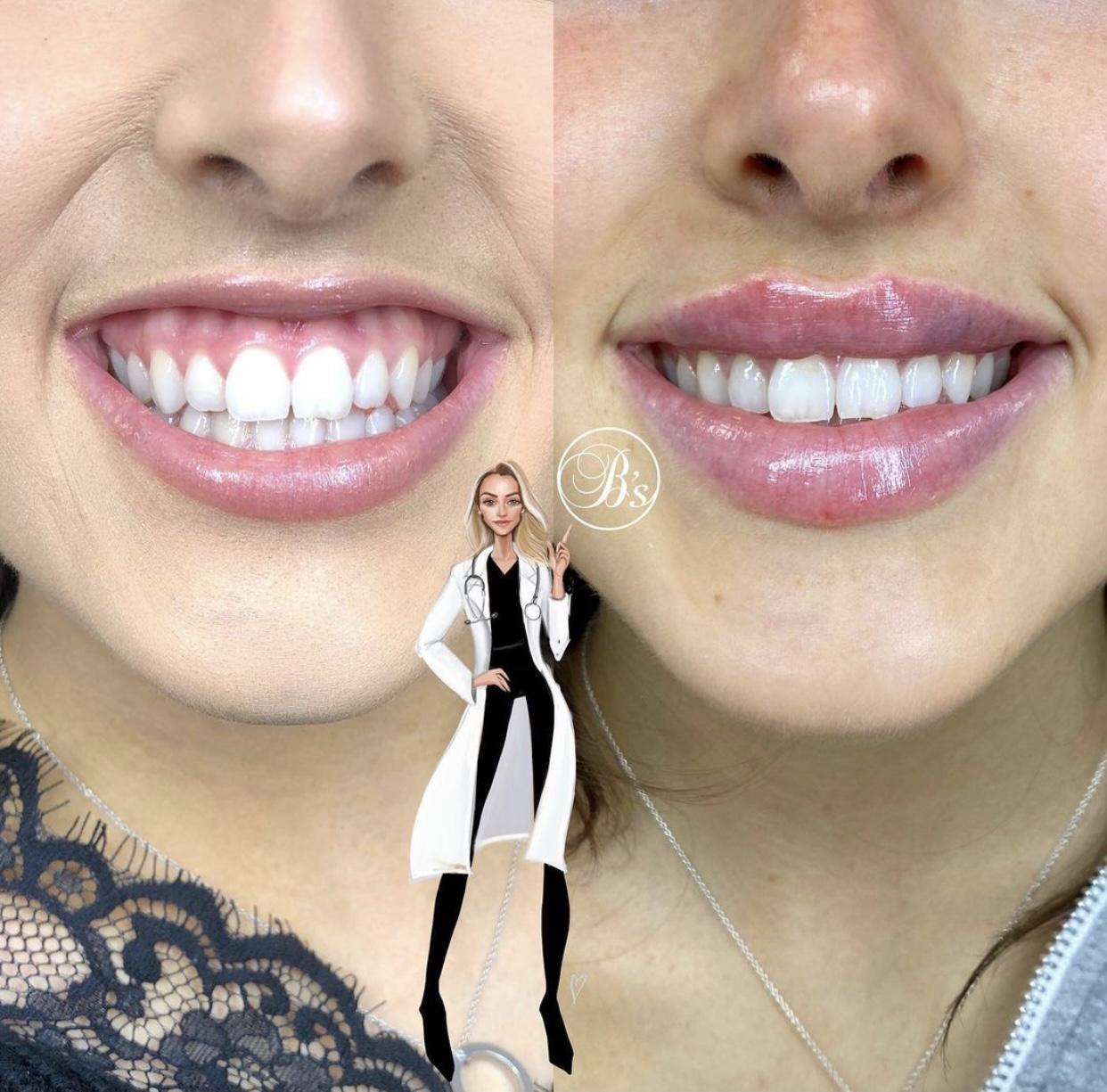 lip-fillers-9