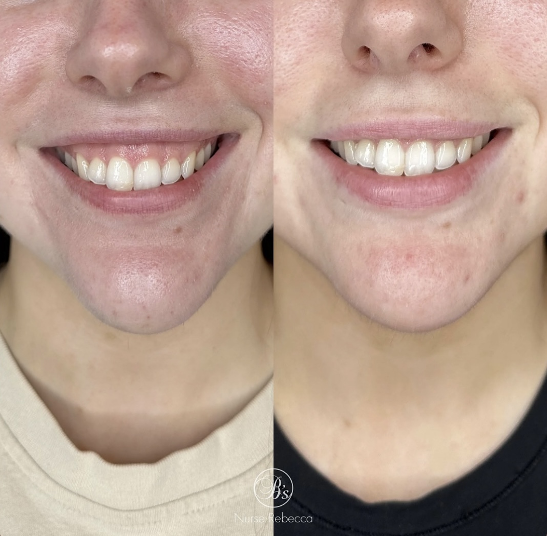 Gummy Smile